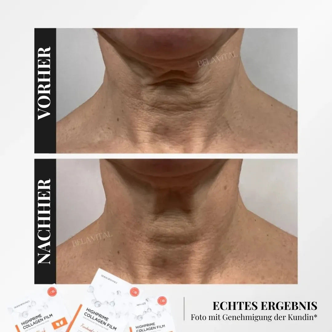 GoldBotox Highprime Kollagen-Masken-Set – Straffende Pflege mit Soforteffekt