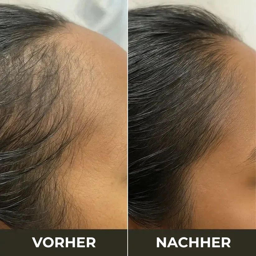 TheraBrush 4-in-1 – Anti-Haarausfall Bürste mit Licht-, Massage- & Aromatherapie