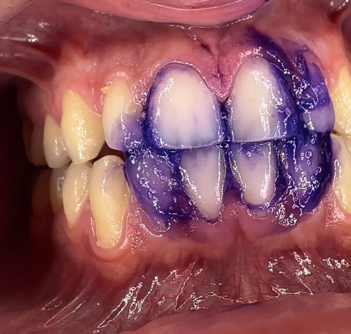 Belavital™ Farbkorrektur-Serum – Sofort Weißere Zähne durch Farbneutralisation